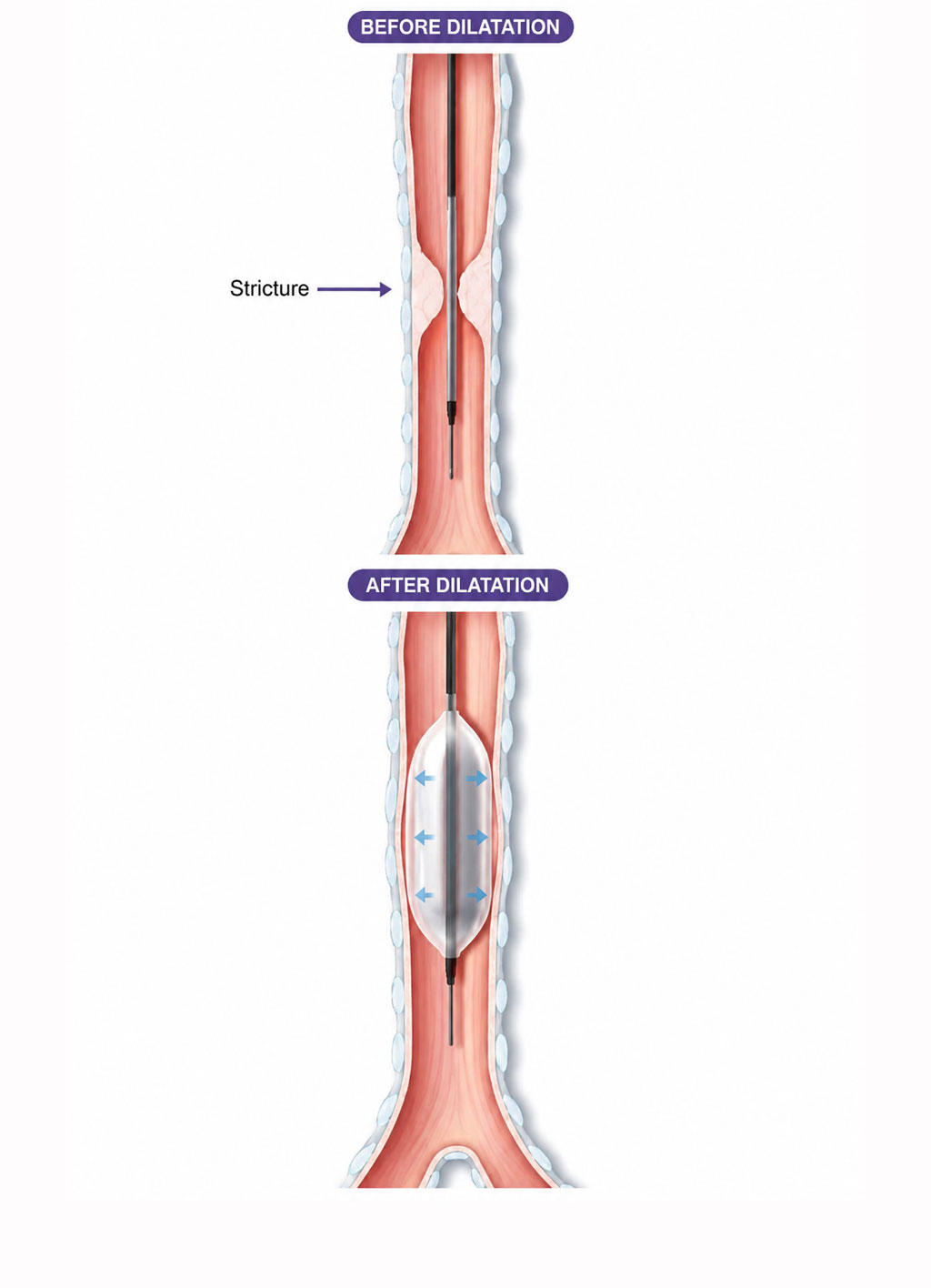 Balloon Dilatation