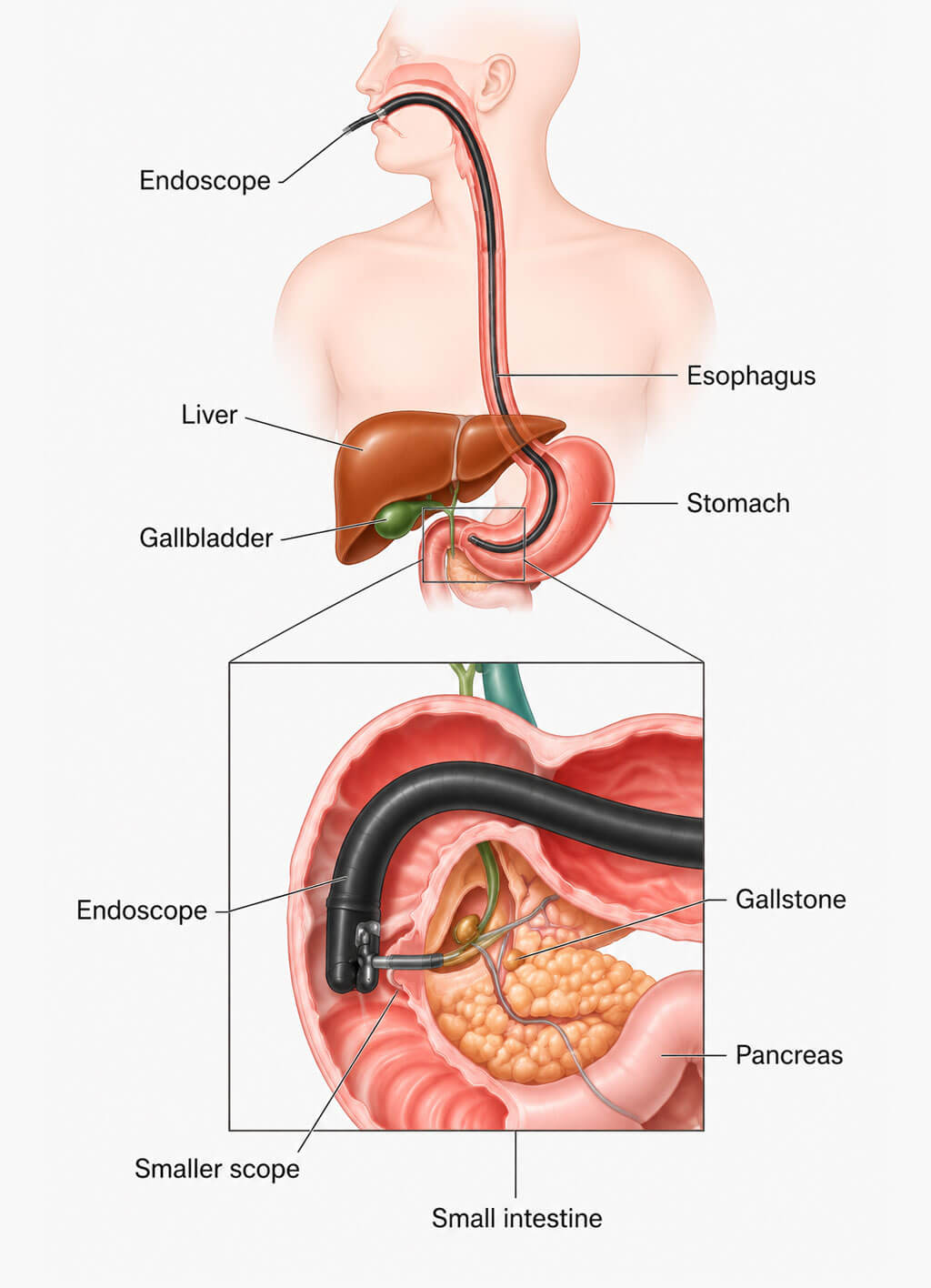 ERCP
