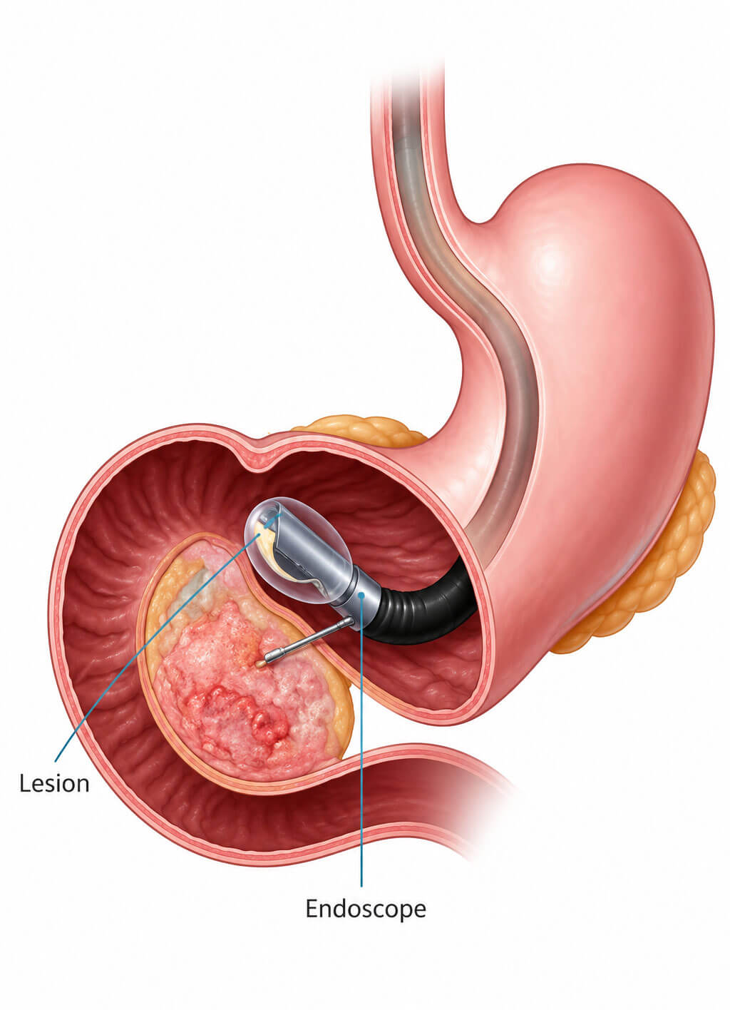 Endoscopic Ultrasound
