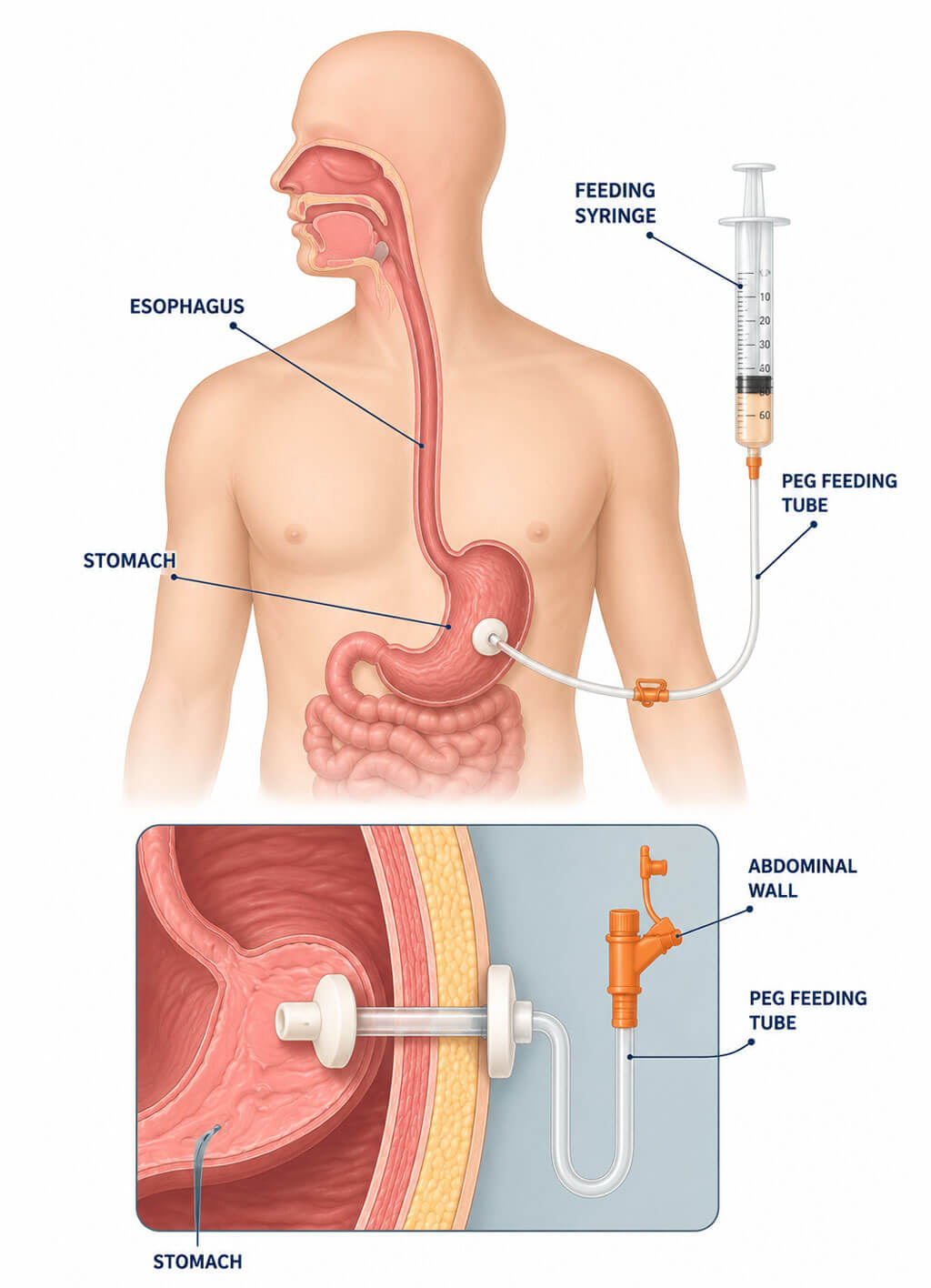 PEG Placement